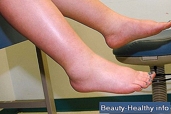 Heavy Leg Syndrome