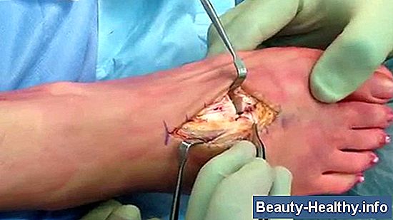 Peroneal Tendon Strækninger