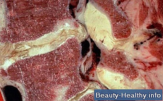 Er Degenerativ Disc Disease kvalificeret som handicap?