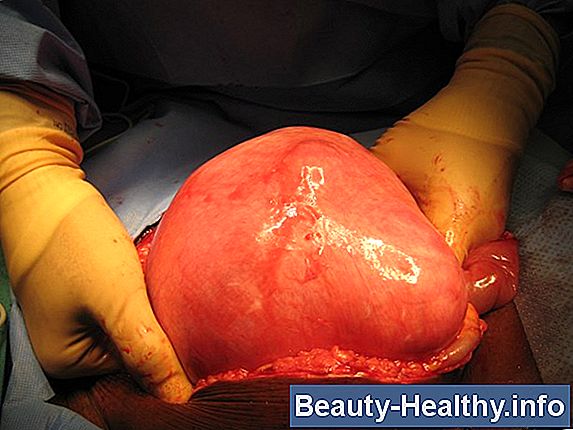 Fibroids & Leg Pain