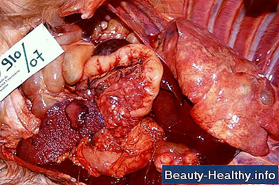 Gallbladder Symptomer Efter Kirurgi