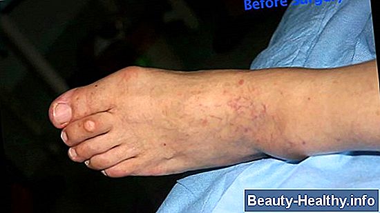Hammertoe Surgery Procedures