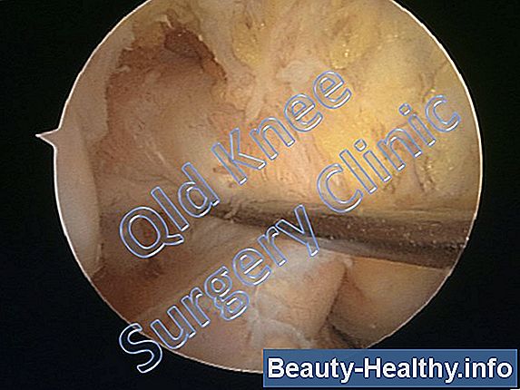 Hyperextended Knee Rehabilitation Øvelser
