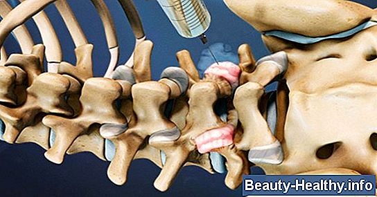 Lumbal Spinal Stenosis Symptomer