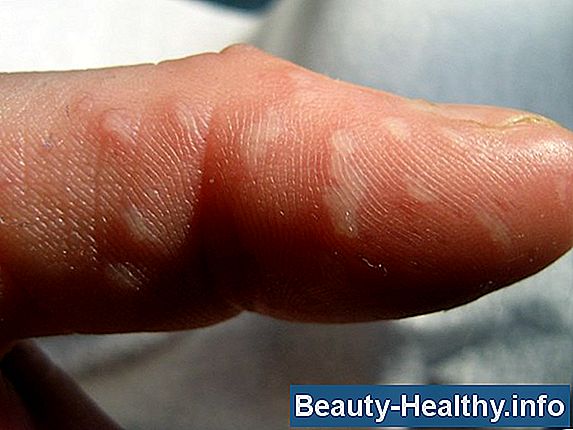 Behandling af HPV-virus hos kvinder