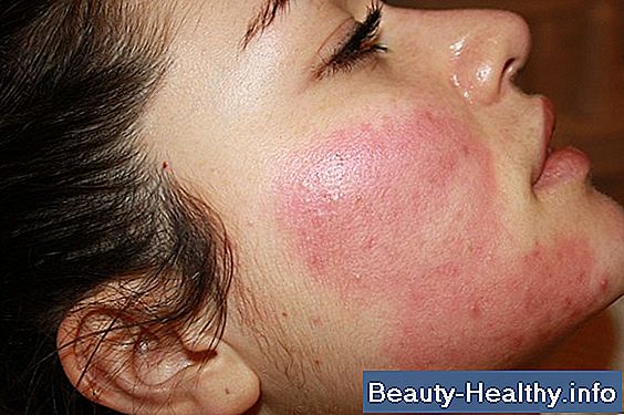 Den bedste behandling for rosacea
