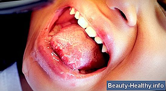 Herpes Stomatitis hos voksne