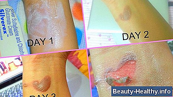 Hjem Remedy for Hot Wax Burn