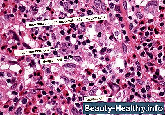 Hodgkins Vs. Non Hodgkins Lymfom: Hvilken behandling er mest behandlet?