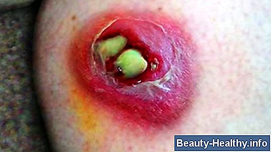 Home Remedies for Yellow Fly Bites