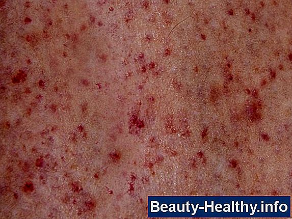 Home Remedy for Cherry Angiomas