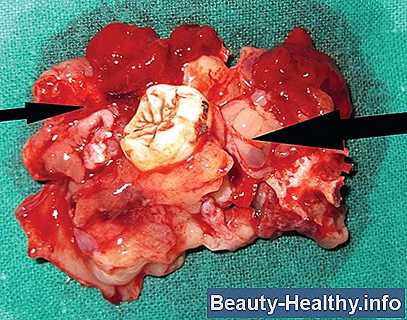 Impacted Sinus Infektion