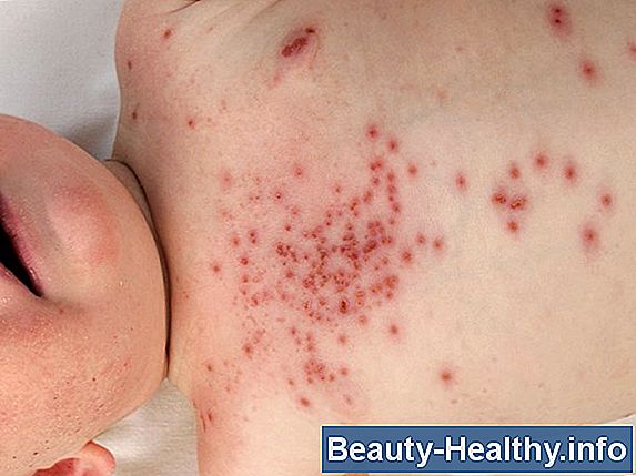 Kan Herpes Simplex forårsage, at dit hår falder ud?