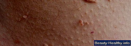 Labia Irritations