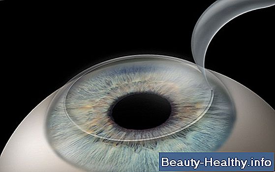 LASIK Eye Surgery Fordele og ulemper
