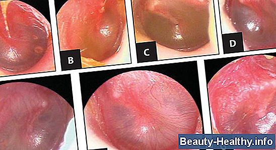 Middle Ear Effusion Treatment