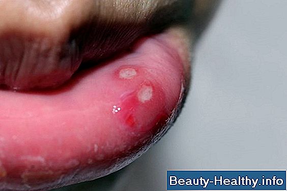 Mund Ulcer Remedy