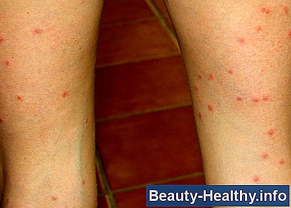 Noseeum Bite Treatment