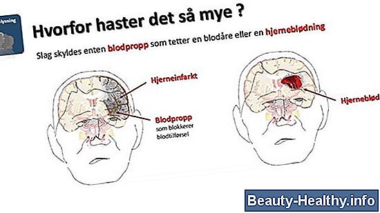 Tegn og symptomer på Thalamus Brain Tumor
