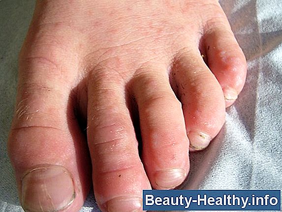 Tegn på, at scabies går væk