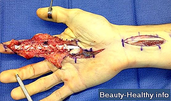 Trigger Finger Cures