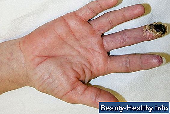 Trigger Thumb og Carpal Tunnel Syndrome Connection