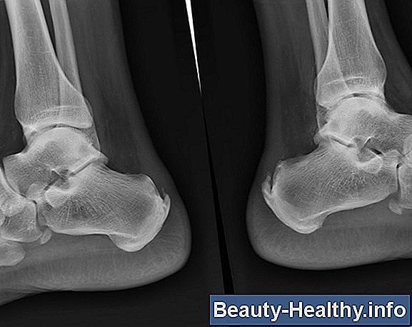 Achilles Tendinitis Übungen
