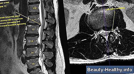 Retrolisthesis Harjoitukset