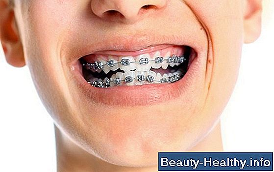 Hoe Clear Braces te verwijderen