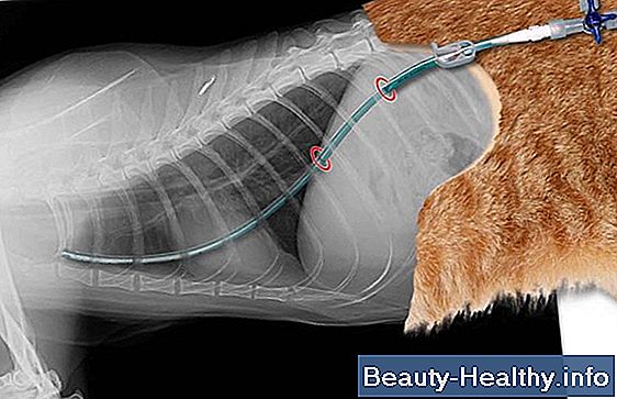 Abdominale stafylokokbesmetting Symptomen