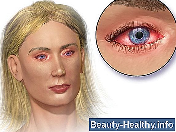 Dermatitis vs. Tiña