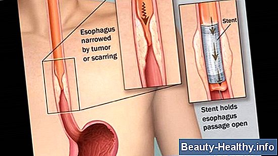 Esophageal Erosion Symptomer