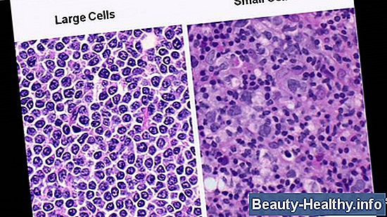 Hodgkins vs. Linfoma no Hodgkins: ¿Cuál es el más tratable?