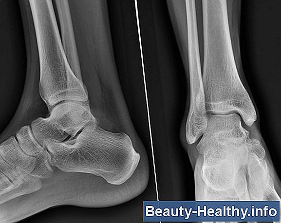 Phlebolith Symptom