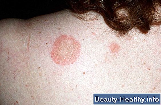 Ringworm Klesvask Råd