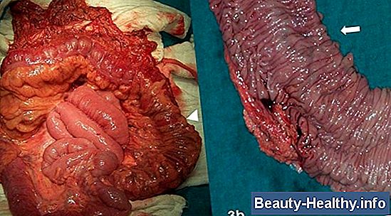 Tortuous Colon Symptomer