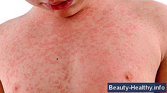 Vanlige symptomer på et hus Spider Bite