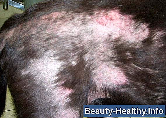 Albue Hyperextended Behandling