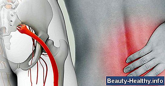 Causes de la douleur brûlante au mollet