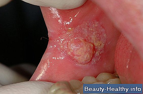 Causes de sensation de picotement et de brûlure dans les jambes et les bras