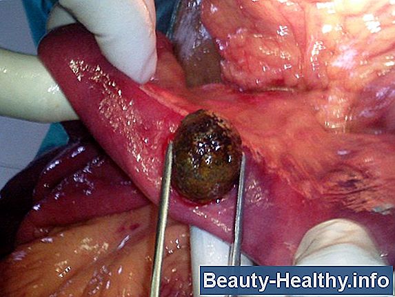 Chirurgie de la vessie