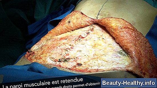 Comment dormir après la chirurgie de coiffe de rotateur