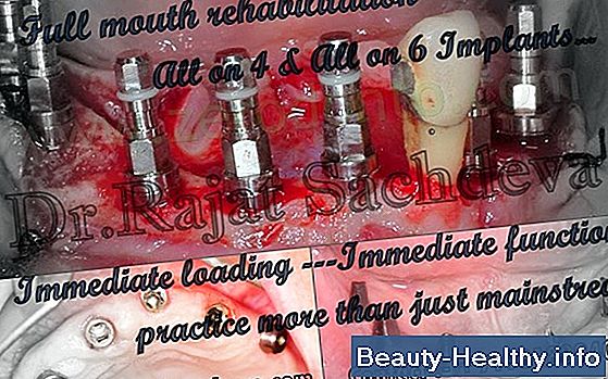 Aftercare for Immediate Dentures