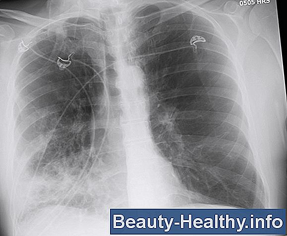 Carcinoid Vs. carcinoma