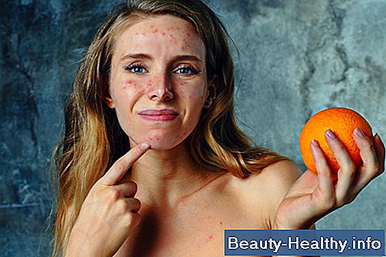 Citrus Allergy Symptoms