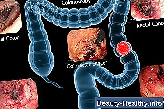 Alcohol y sangrado rectal