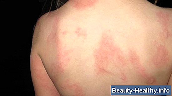 Fast Poison Ivy Cures