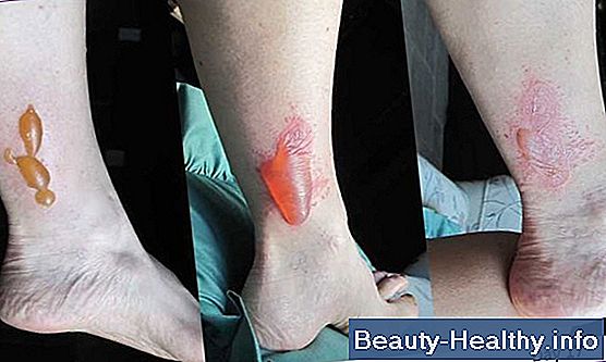 Stages of Poison Ivy Rash