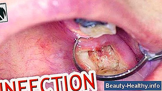 Impacted Sinus Infection