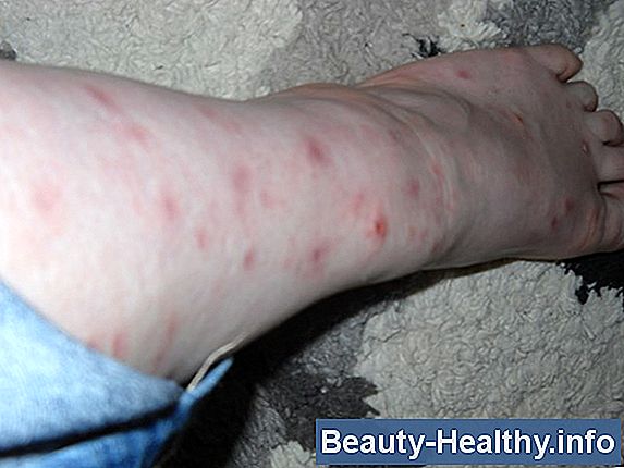 Noseeum Bite Treatment